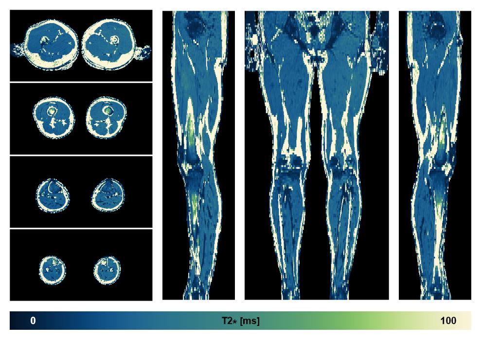 The T2 star relaxation time of the lower extremity obtained from the dixon reconstruction for muscle water fat quantification.